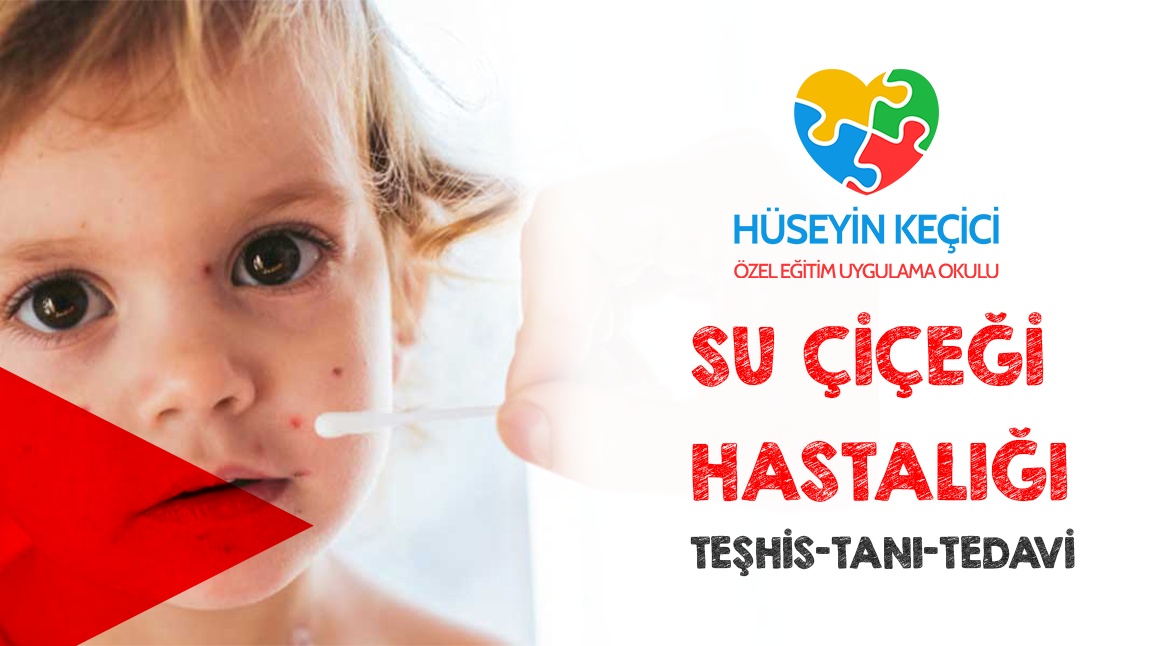 Su Çiçeği Hastalığı Broşürü